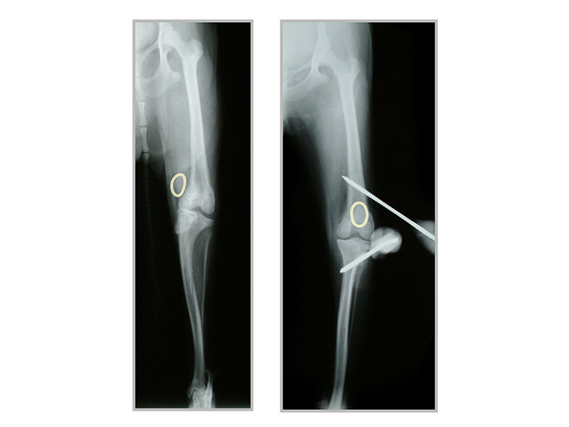 DEFK手術（Dynamic External Fixation for Knee）